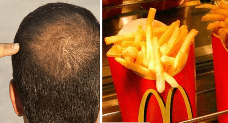 frites mcdo calvitie