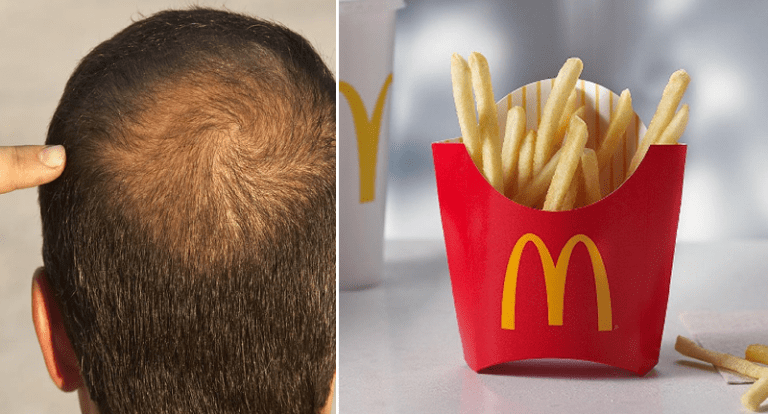 frites mcdo calvitie2
