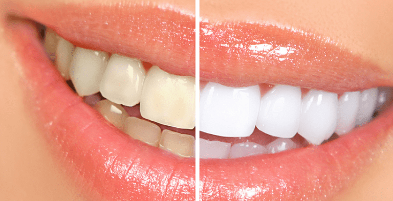 image dents
