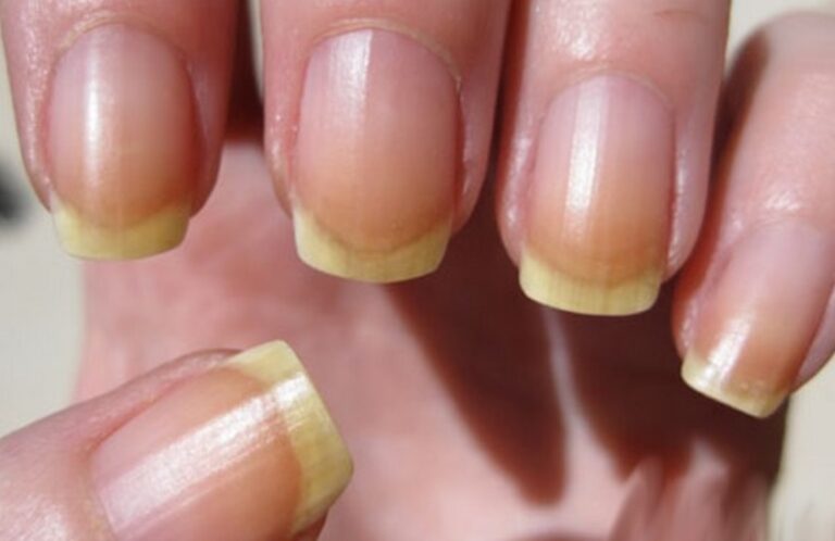 sante-ongle-jaune