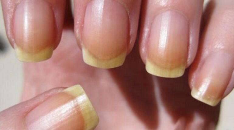Vous avez des ongles jaunes ? Attention à ces problèmes de santé effrayants ! alimentation variee boire de l'eau Confort mains ongles ongles jaunes santé santé France santé nutrition traitement tranquillité vernis a ongles zénitude