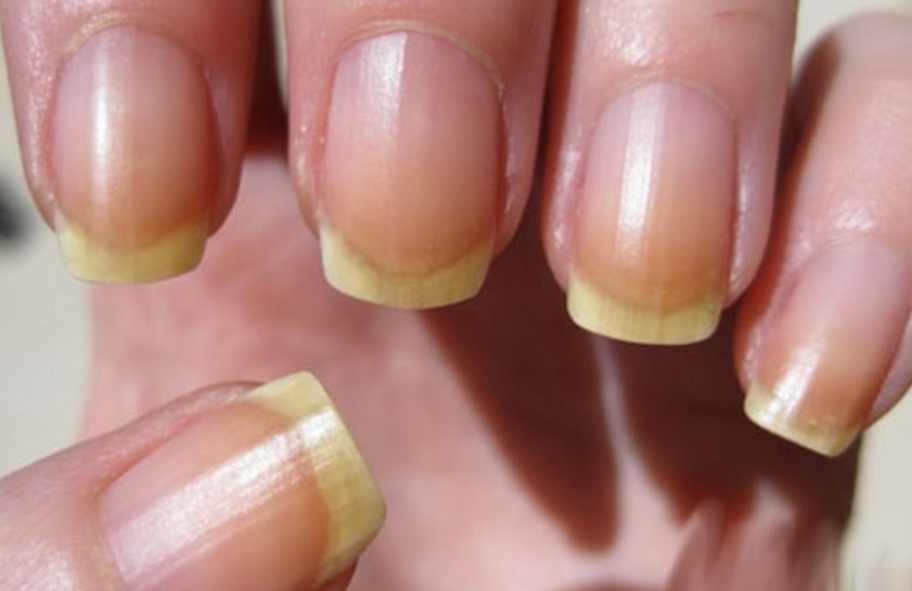 sante-ongle-jaune sante-ongle-jaune