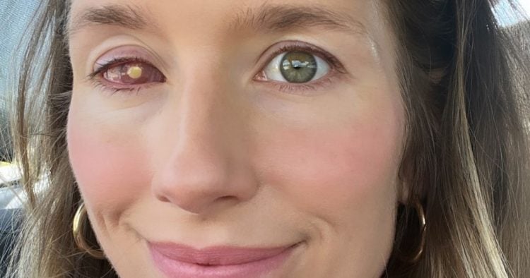 Il devient aveugle après