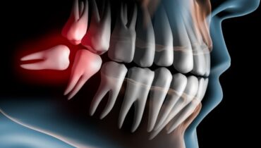 Opération des dents de sagesse : tout savoir sur le processus d’extraction