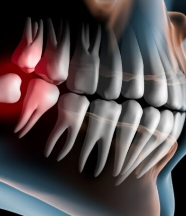 Opération des dents de sagesse : tout savoir sur le processus d’extraction