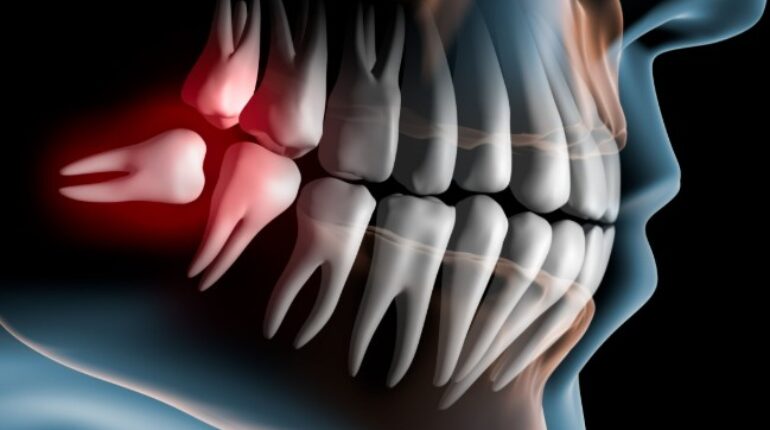 alimentation alvéolite anesthésie chirurgie dentaire cicatrisation complications dents de sagesse douleurs Edmond Binhas extraction gencive opération orthodontie racine sutures
