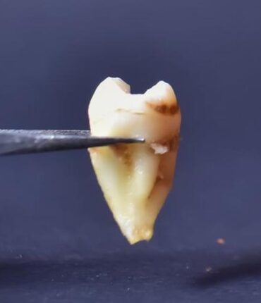 Port-Vendres : elle mord dans son plat et fait une découverte qui la dégoûte pendant deux jours