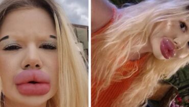 Baume à lèvres Beauté chirurgie esthétique influenceuse Méconnaissable transformation