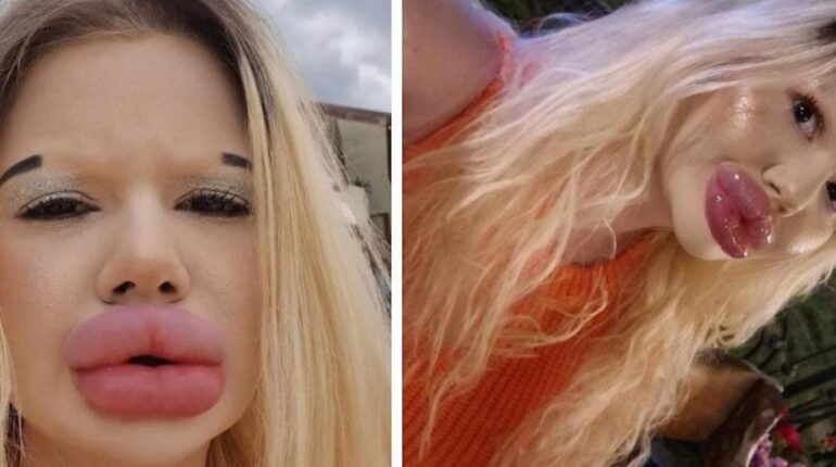 Baume à lèvres Beauté chirurgie esthétique influenceuse Méconnaissable transformation