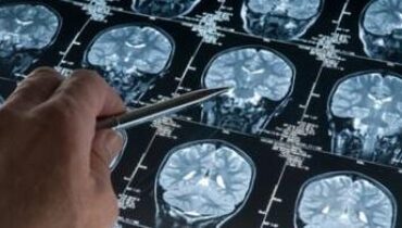 Alzheimer environnement Microplastiques Neurosciences Pollution Santé Cérébrale