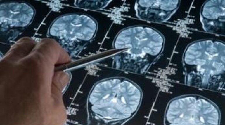 Alzheimer environnement Microplastiques Neurosciences Pollution Santé Cérébrale