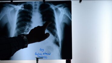 À Saint-Brieuc, 451 enfants surexposés aux rayons X : la découverte qui a tout révélé