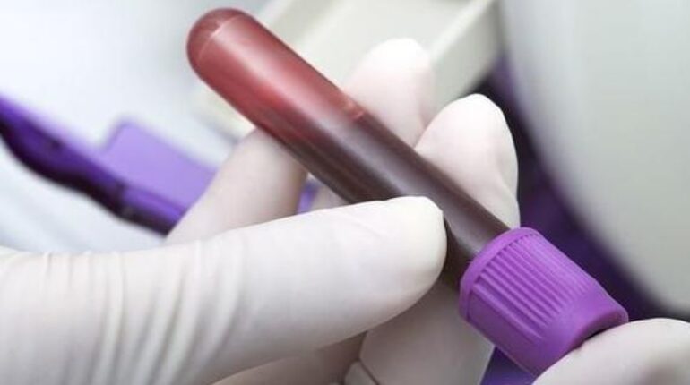 Cancer du poumon : un test sanguin détecte la maladie jusqu’à 4 ans avant l’imagerie médicale Cancer du poumon dépistage cancer diagnostic précoce recherche médicale Thérapies ciblées