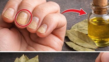 Bienfaits santé feuilles de laurier mycoses ongles Remèdes naturels soins des ongles Vinaigre de cidre