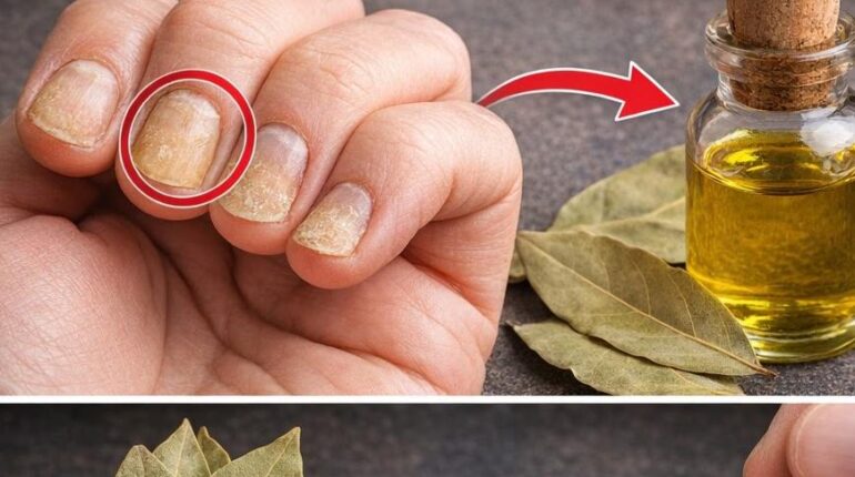 Bienfaits santé feuilles de laurier mycoses ongles Remèdes naturels soins des ongles Vinaigre de cidre