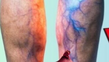 bien être Circulation sanguine Remèdes maison Santé des jambes Soins naturels Varicosités