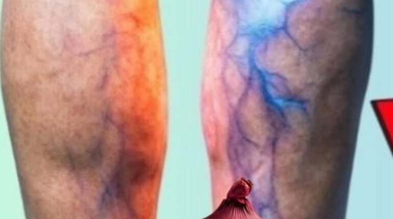 bien être Circulation sanguine Remèdes maison Santé des jambes Soins naturels Varicosités