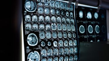 Belgique Boissons énergisantes Diagnostic médical intelligence artificielle Pédiatrie Tumeur cérébrale