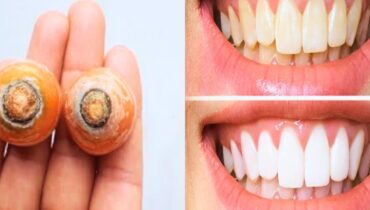 Blanchiment des dents Fanes de carottes Remèdes naturels santé bucco-dentaire Soins des dents tartre