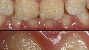 Amélogenèse Imparfaite Dents Fragiles Émail dentaire Prévention caries Santé dentaire Trouble Génétique
