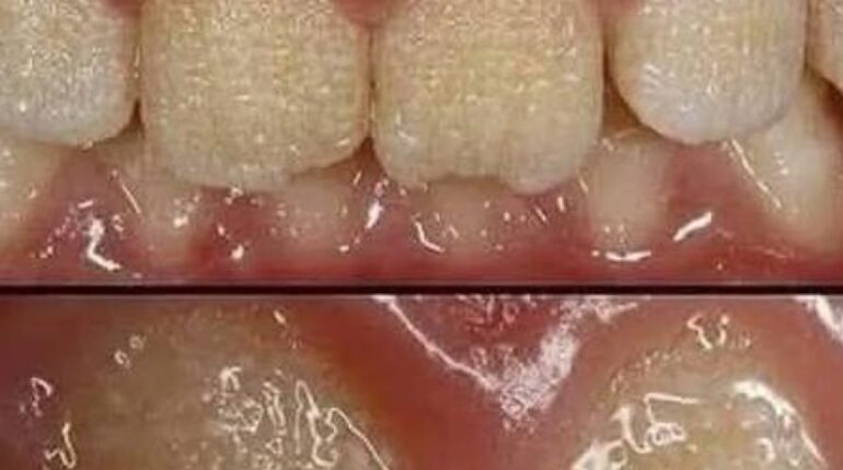 Amélogenèse Imparfaite Dents Fragiles Émail dentaire Prévention caries Santé dentaire Trouble Génétique