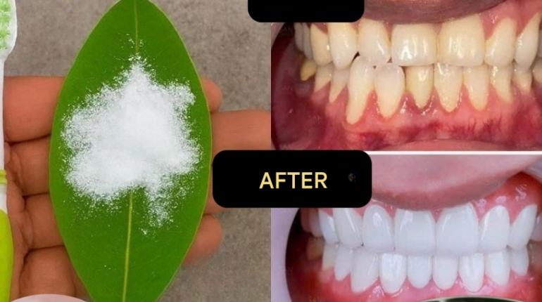 Blanchiment des dents Feuilles de goyave Haleine fraîche Hygiène dentaire Remèdes maison Soins naturels