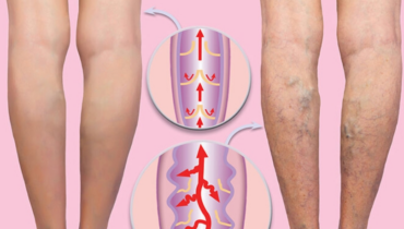 Aloe vera Jambes lourdes Remède naturel Soin de la peau Varicosités Vinaigre de cidre