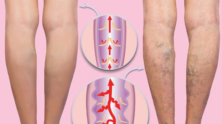 Aloe vera Jambes lourdes Remède naturel Soin de la peau Varicosités Vinaigre de cidre