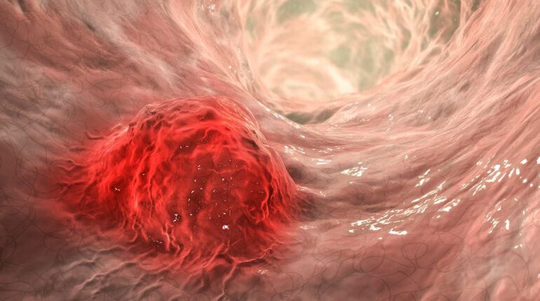 Ces 5 signes que votre corps vous envoie et que vous ne devriez jamais ignorer Boissons énergisantes cancer cancer colorectal dépistage cancer prévention symptômes