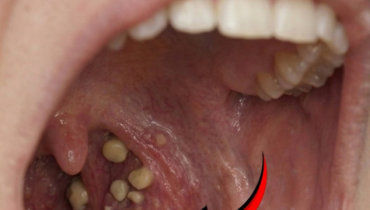 amygdales calculs amygdaliens hygiène buccale mauvaise haleine Remèdes maison santé bucco-dentaire