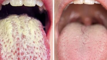 bien être Hygiène bucco-dentaire Langue blanche Remèdes naturels Santé buccale symptômes