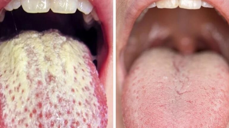 bien être Hygiène bucco-dentaire Langue blanche Remèdes naturels Santé buccale symptômes