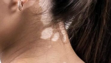 diagnostic Eczéma Infections fongiques Soins de la peau Tinea Versicolor Troubles cutanés