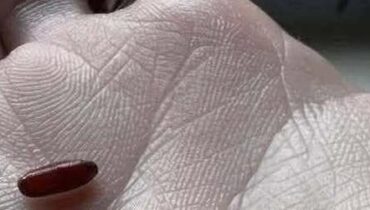 Accidents domestiques Astuces santé Encéphalite Infections bactériennes Maladies transmises par tiques Virus Powassan