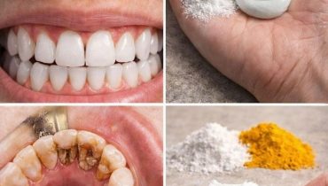 bicarbonate de soude Blanchiment dents Curcuma Hygiène bucco-dentaire Remède maison Soin Naturel 
