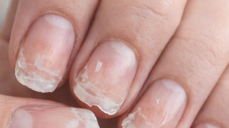 Astuces santé bien être Carences Nutritionnelles ongles soins des ongles