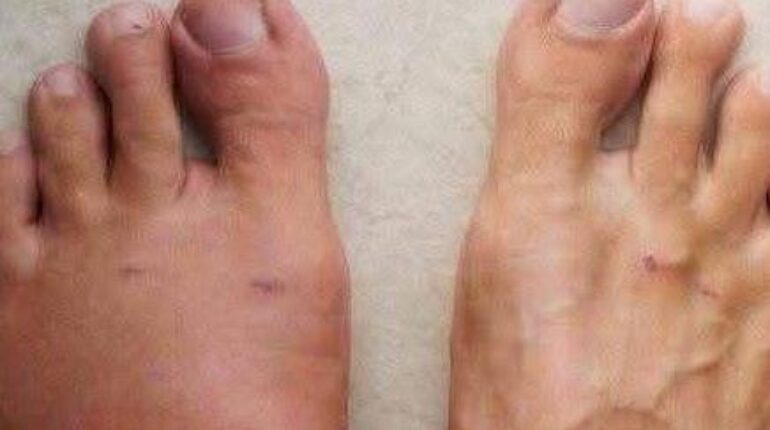 Bienfaits santé Crise cardiaque Maladie cardiovasculaire prévention Restos du Cœur symptômes