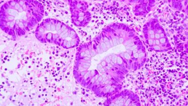 Accepter le traitement Apithérapie cancer distilled vinegar Nanoparticules recherche médicale