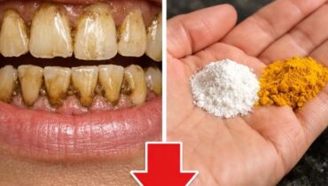 bicarbonate de soude Curcuma Hygiène bucco-dentaire Médecine ayurvédique Remèdes naturels Soins dentaires