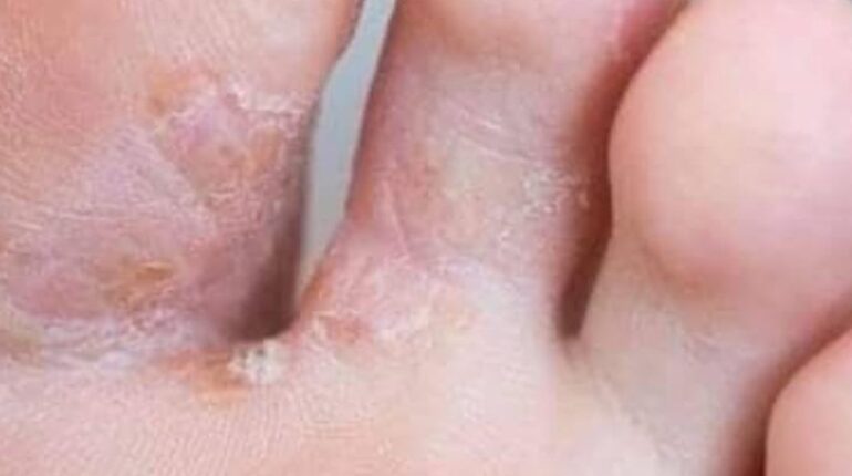 Bienfaits santé diabète glycémie prévention Soins des pieds symptômes