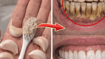 bicarbonate de soude Blanchiment des dents Dents blanches Peroxyde d'hydrogène Soins bucco-dentaires Taches dentaires 