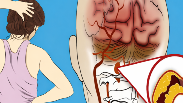 Alimentation Santé AVC Neurologie prévention symptômes Urgence médicale 