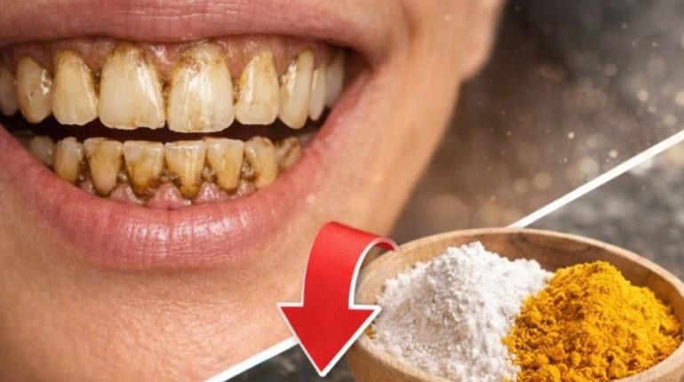 bicarbonate de soude Blanchiment dents Curcuma Hygiène bucco-dentaire Médecine ayurvédique Remède naturel 