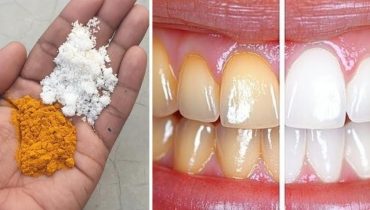 Blanchiment des dents Curcuma Dents saines Hygiène dentaire Remèdes naturels santé bucco-dentaire 