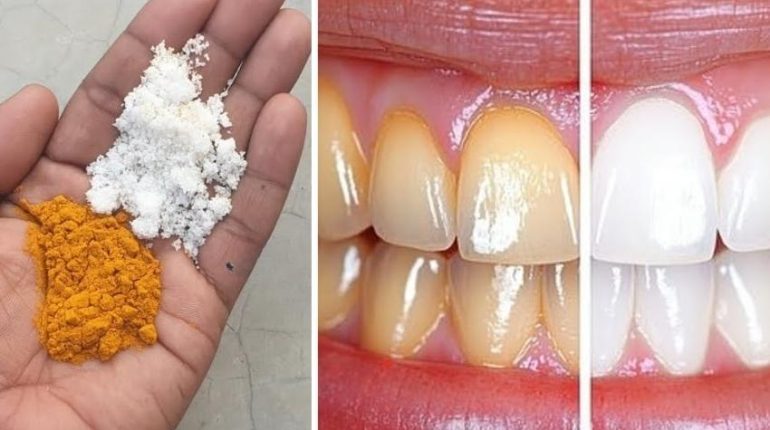Blanchiment des dents Curcuma Dents saines Hygiène dentaire Remèdes naturels santé bucco-dentaire 