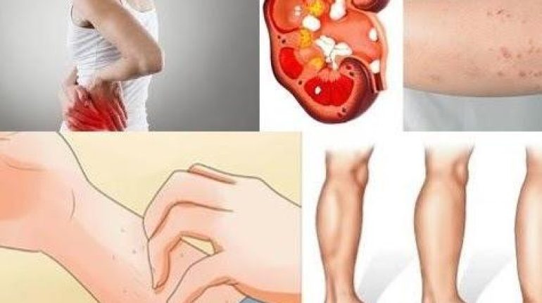 Bien-être rénal Dysfonctionnement rénal Fonction rénale Santé Rénale Signes avant-coureurs Symptômes rénaux 