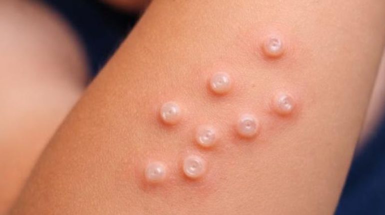 allaité trois enfants Cancer de la peau Dermatologie Infections cutanées Molluscum contagiosum santé enfant 