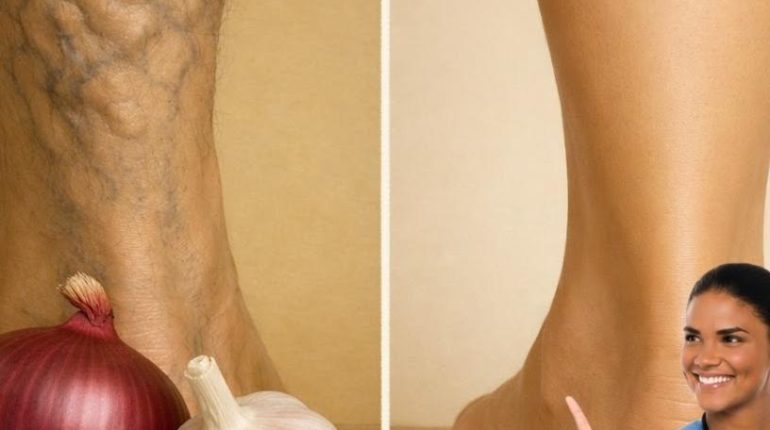 Absence au travail Ail et oignon Bien-être jambes Circulation sanguine Remèdes naturels Santé vasculaire 