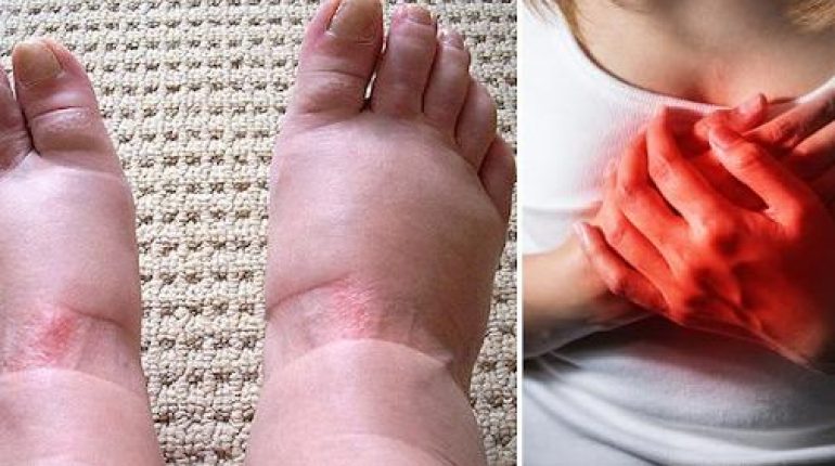 Alimentation Santé Alternatives foie gras maladies cardiaques Pieds gonflés Problèmes rénaux rétention d'eau symptômes 