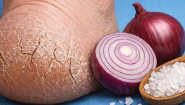 Beauté des pieds Déshydratation Peau sèche Remèdes naturels Soins des pieds Talons craquelés 